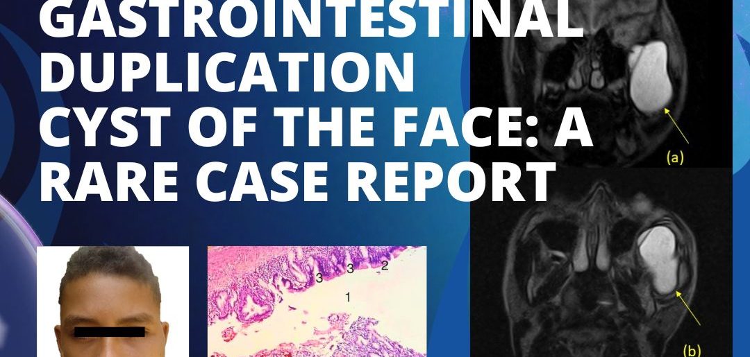 Congenital heterotopic gastrointestinal duplication cyst of the face: a rare case report